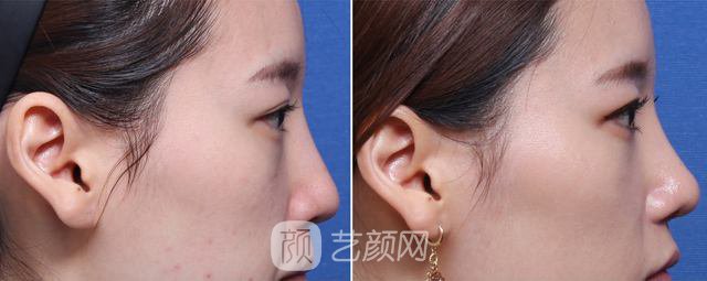 耳软骨隆鼻果好吗?耳软骨隆鼻果图~