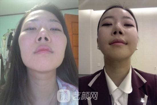 上海颧骨手术多少钱?