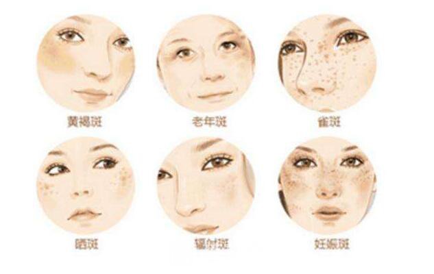 黄褐斑和雀斑的区别