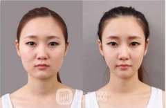 为什么注射瘦脸价格越来越便宜?艺颜网告诉你其中秘密