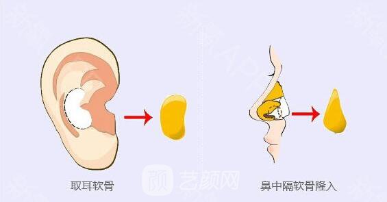 耳软骨隆鼻尖有什么优势？