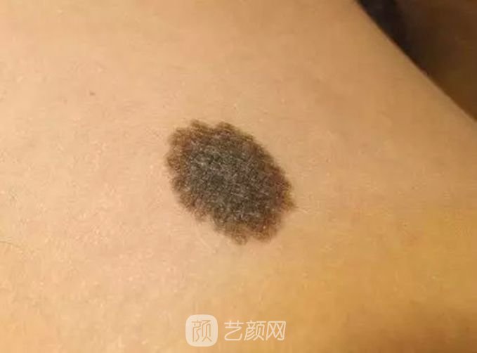 北京激光去痦子多少钱？