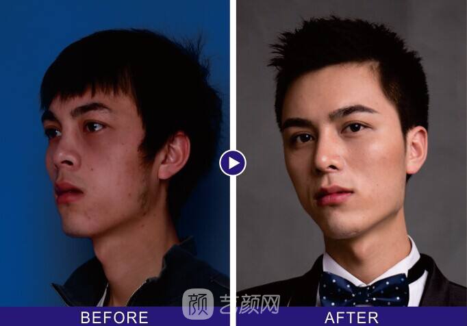 硅胶隆鼻果好吗?硅胶隆鼻果~