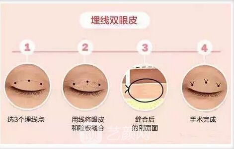 埋线双眼皮多久可以恢复自然