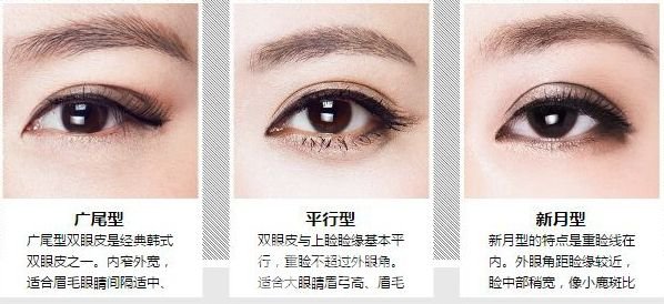 　苏州内双割双眼皮多少钱