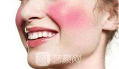 激光去红血丝多少钱，那里可以做?