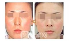 复合彩光去红血丝果怎么样了，价格贵不贵？