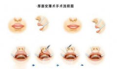 瘦唇针多少钱一针