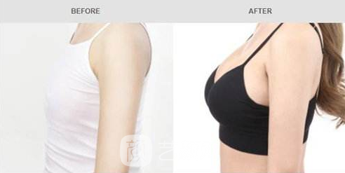 深圳娜高假体隆胸多少钱?