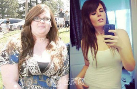 水动力吸脂手术有什么优势?