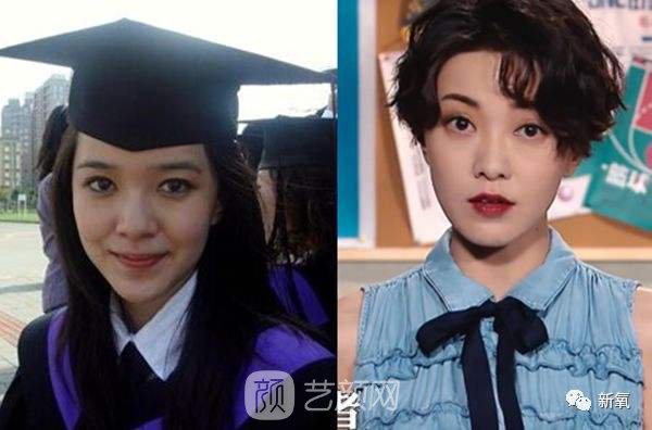 鼻头缩小,鼻头缩小果好吗?