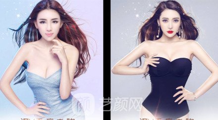 娜高假体隆胸术后多久恢复