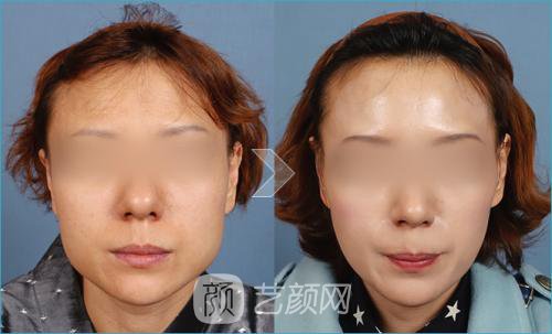 下颌角磨骨有后遗症吗？下颌角磨骨后遗症有哪些？