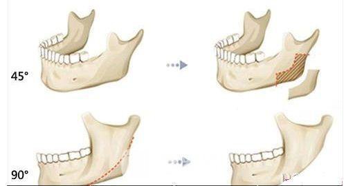 下颌角磨骨有后遗症吗？下颌角磨骨后遗症有哪些？