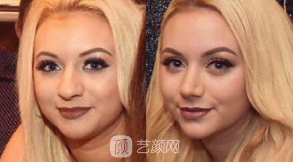 自体肋软骨隆鼻价格大概多少钱?