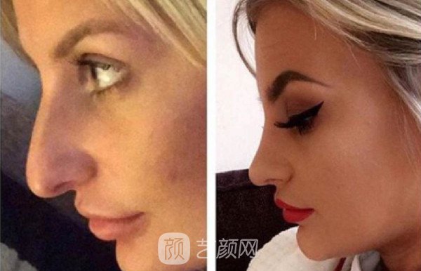 自体肋软骨隆鼻价格大概多少钱?