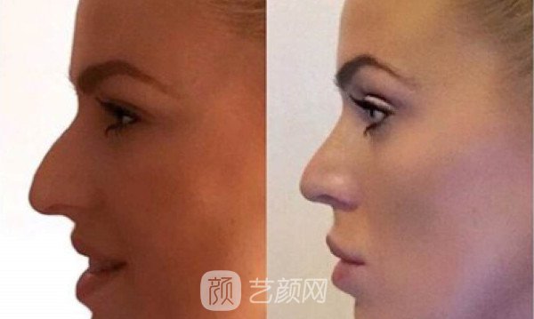 自体肋软骨隆鼻价格大概多少钱?