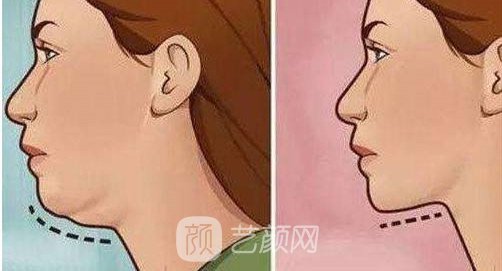 深圳磨尖下巴骨多少钱?