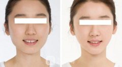上海颧骨磨骨手术多少钱