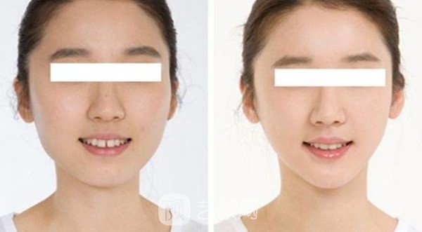【上海颧骨磨骨手术多少钱？】