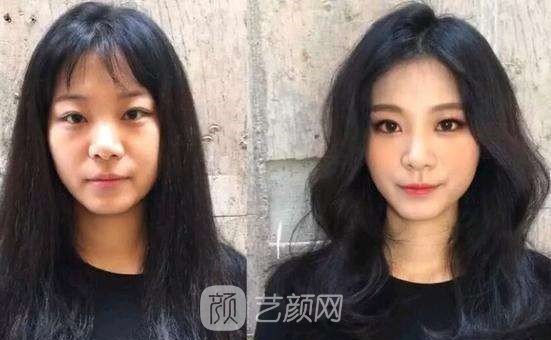 【上海颧骨磨骨手术多少钱？】
