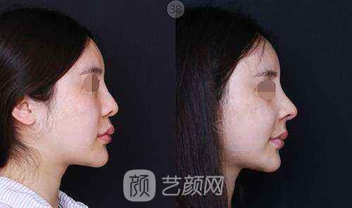 自体肋软骨隆鼻后多久可以运动