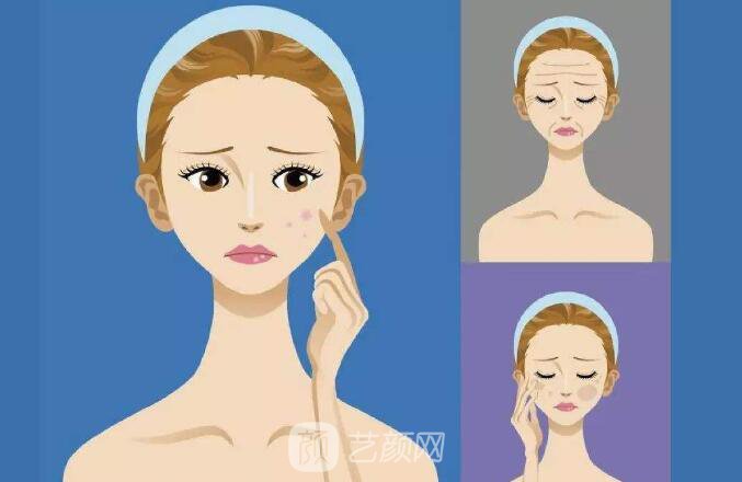 光子嫩肤去毛孔和黑头