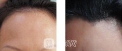 美人尖种植大概需要多少钱