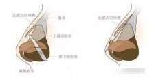 金华驼峰鼻矫正费用大概多少