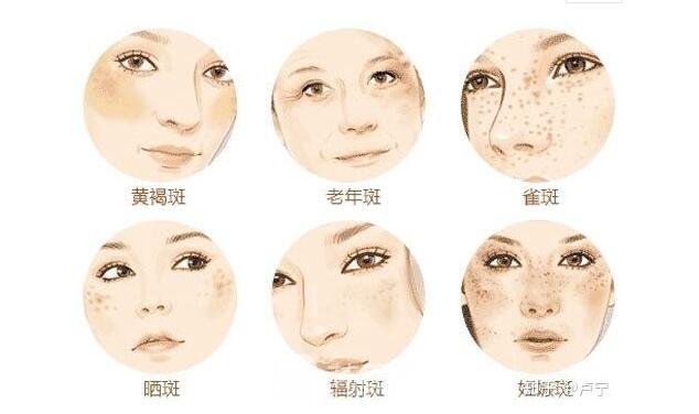 成都c8激光祛斑多少钱?