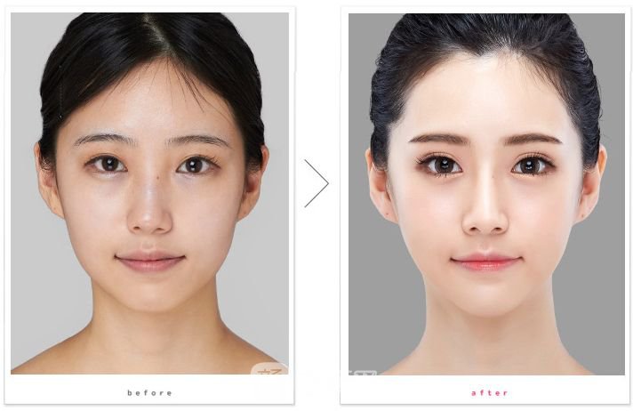 天津下颌角磨削一般多少钱?