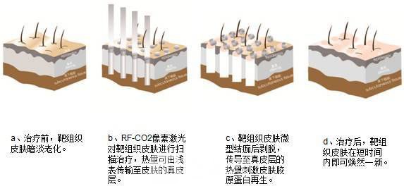 像素激光换肤是什么?像素激光换肤有什么特点?