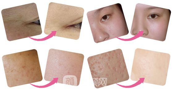 唐山做全身光子嫩肤价格大概多少钱？