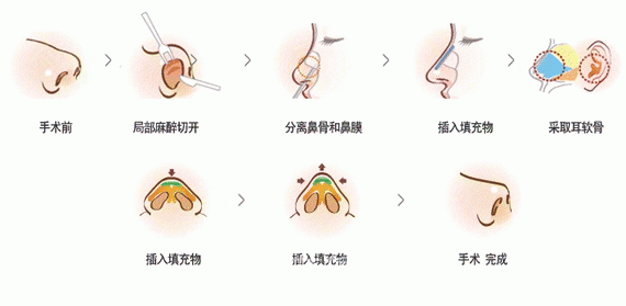上海耳软骨垫鼻尖多少钱?