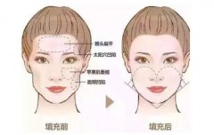 整形美容，脂肪填充术大概需要多少钱了
