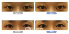 开外眼角图，开眼角需要多少钱?