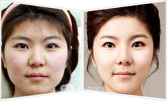 成都面部吸脂瘦脸多少钱?