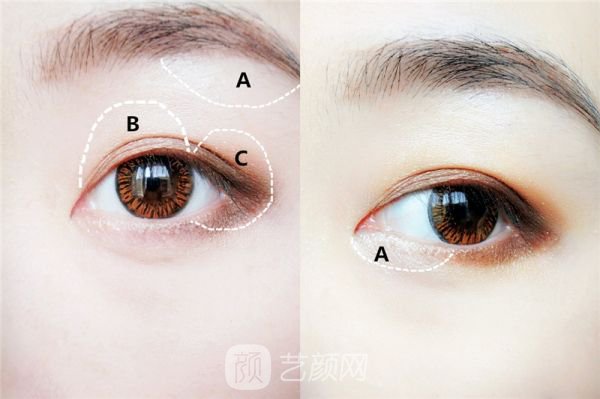 自体脂肪填充眼窝多少钱?