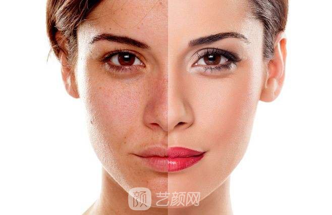 北京注射瑞蓝玻尿酸多少钱?