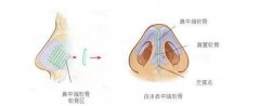 成都做肋软骨隆鼻要多少钱?影响价格因素有什么?