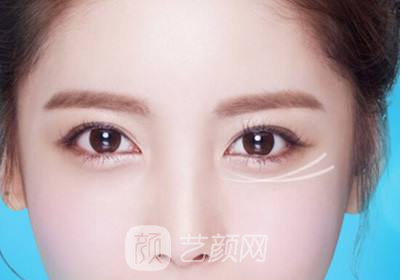 注射隆鼻有后遗症吗?注射隆鼻后遗症有哪些?