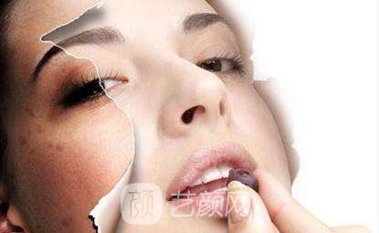 黄褐斑怎么去除果比较好?