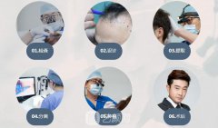 杭州植发手术费用大概多少?