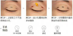 上海韩式三点双眼皮价格多少?