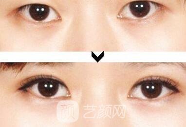 上海韩式三点双眼皮价格多少?