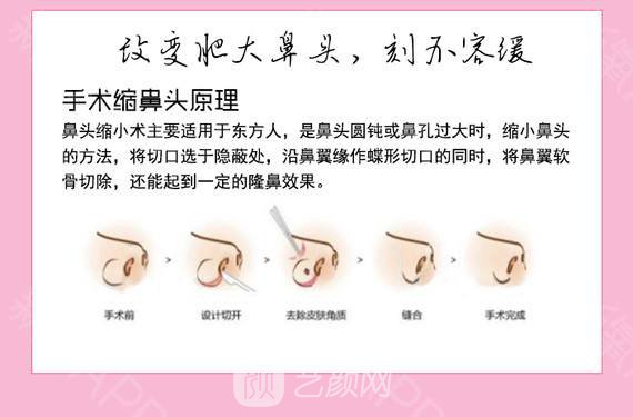 鼻头缩小大概多少钱