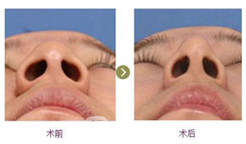 鼻头缩小大概多少钱