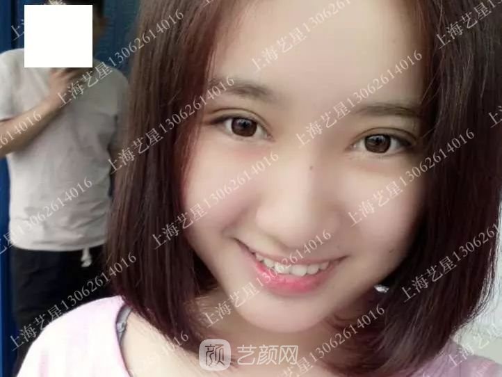 上海艺星割双眼皮术后一个月恢复日记一则~