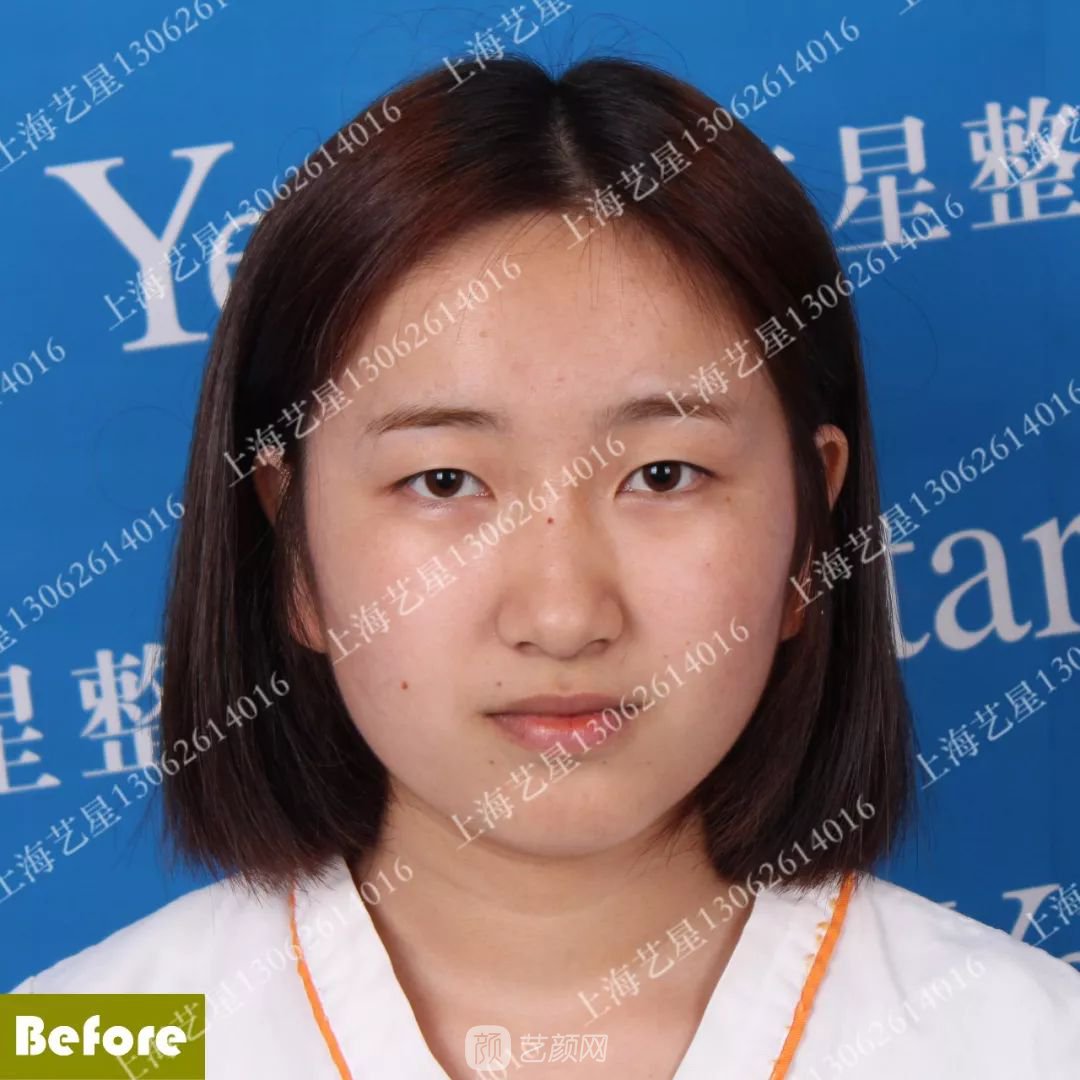 上海艺星割双眼皮术后一个月恢复日记一则~
