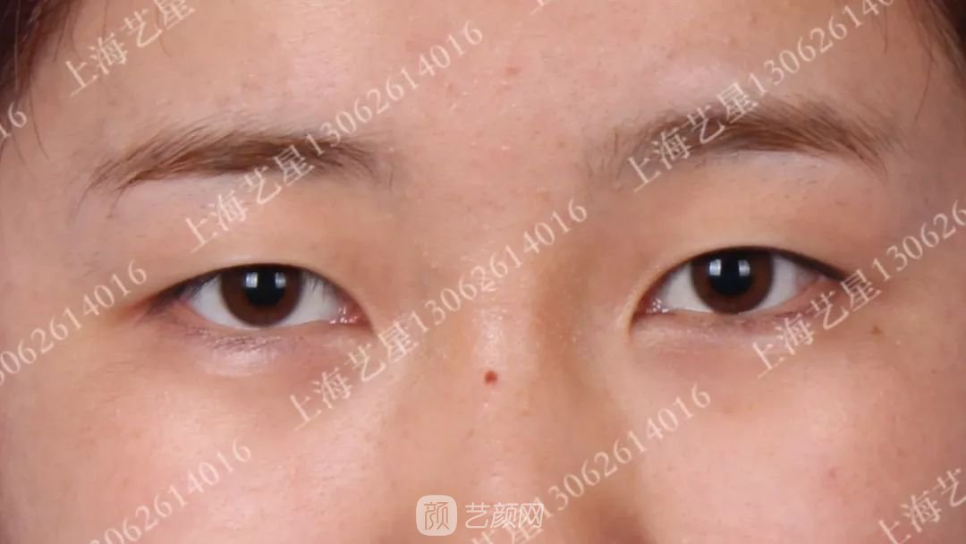 上海艺星割双眼皮术后一个月恢复日记一则~